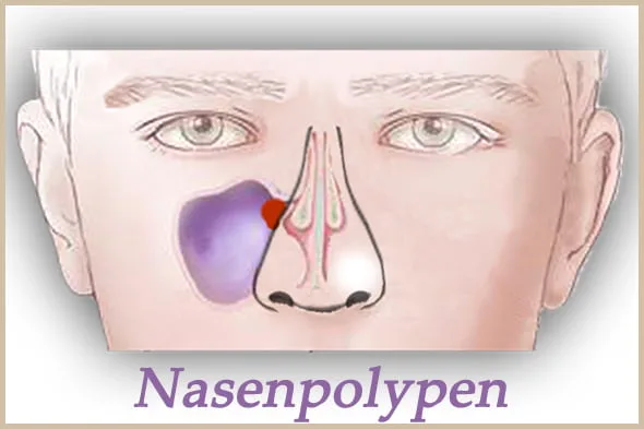 nasenpolypen