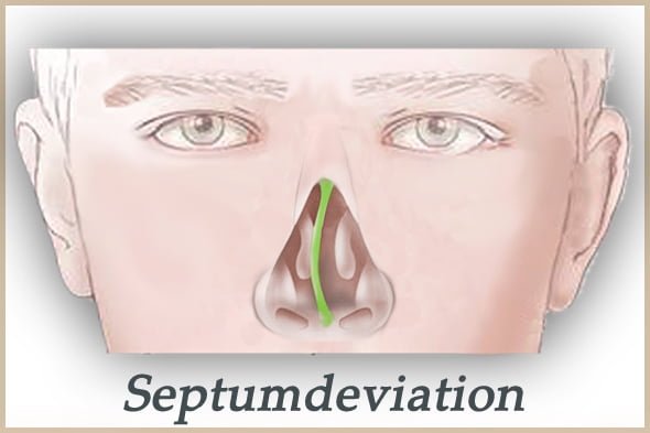septumdeviation